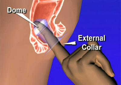 Female Condom Anal Sex 45